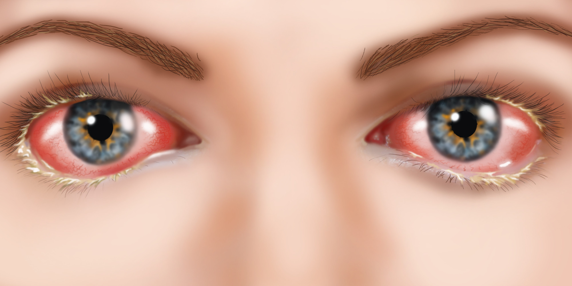 what-is-pink-eye-and-how-can-you-prevent-it