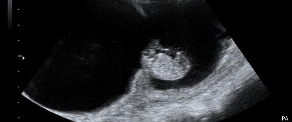 Abortion