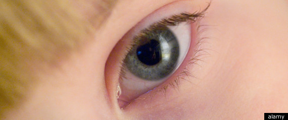 Blinking Patterns Autism
