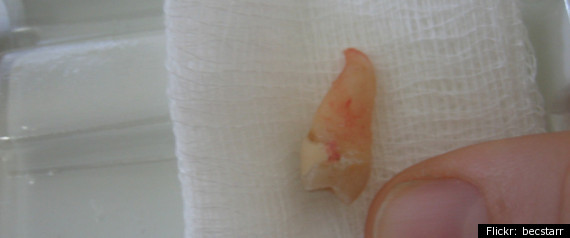 Wisdom Tooth