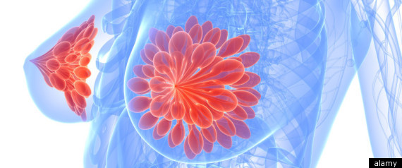 Genetic Test That Could Cut Chemotherapy Rates
