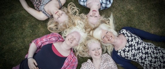 jovenes albinos