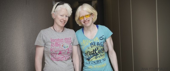 gafas albinos