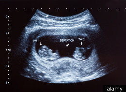Is IVF Fuelling The Rise In Abortions Of Multiple Births?