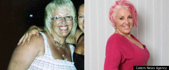 Gastric Band