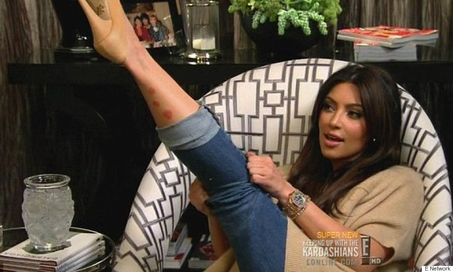 Kim Kardashian Isn't Afraid To Show Her Psoriasis
