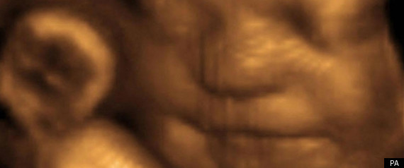 Foetus
