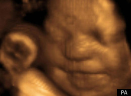Catholic Midwives Take NHS To Court Over Abortions