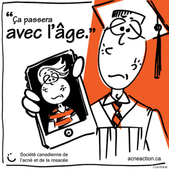 acné1