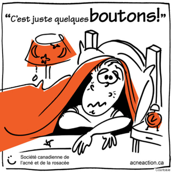 acné 2
