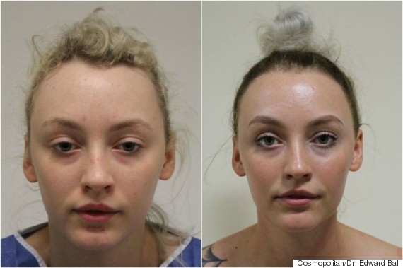 hair loss