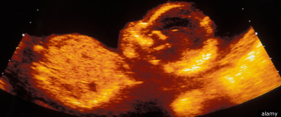 Texas Sonogram Law