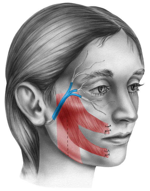 facial nerve paralysis