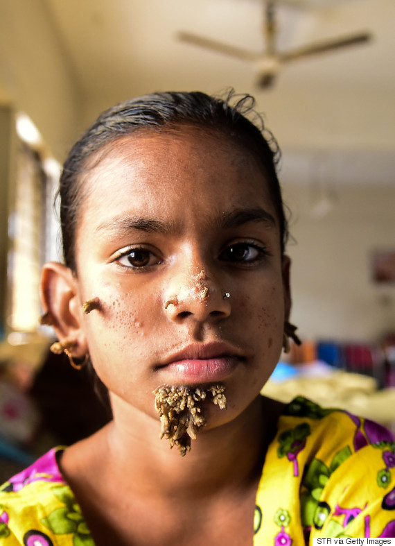 sahana khatun  10χρονη από το Μπαγκλαντές ίσως είναι η πρώτη γυναίκα με το σύνδρομο «άνθρωπος δέντρο» o SAHANA KHATUN 570