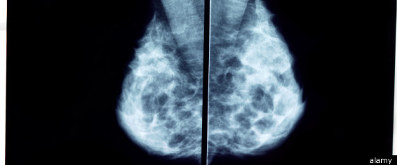 Breast Cancer Gene