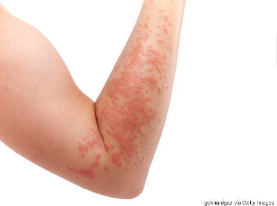 eczema