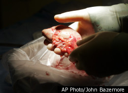 Weird Organ Transplant Tales