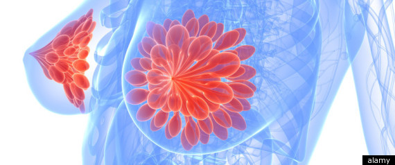 Breast Cancer Older Women