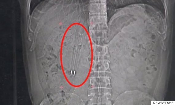 xray