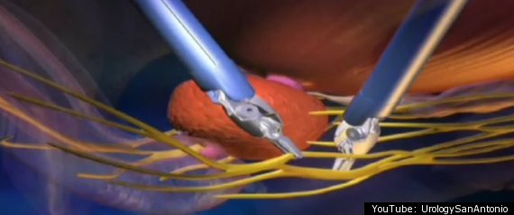 Robot Performs Penis Surgery