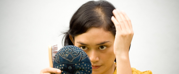 تساقط الشعر ليس دائماً وراثياً.. وهذه الأطعمة تحميك من الصلع N-HAIR-LOSS-large570