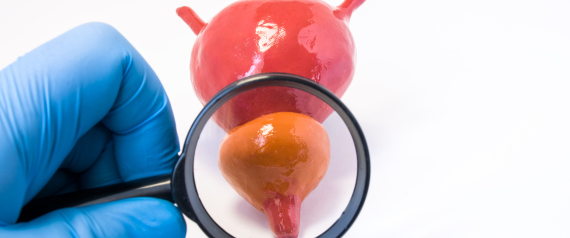 PROSTATE ENLARGEMENT