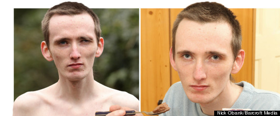 Anorexic Barcroft Marc Corn