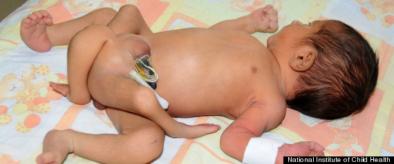 Baby With Six Legs
