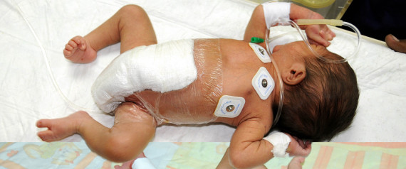 Baby With Six Legs