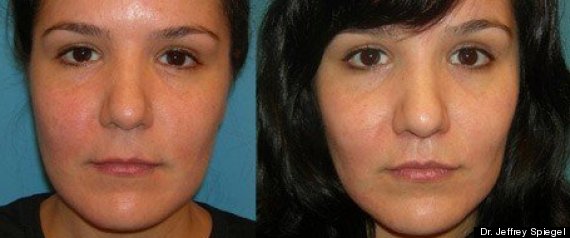 Liplift456