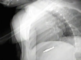 Little girl's X-ray