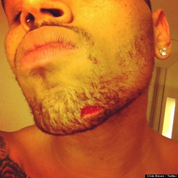 Chris Brown And Drake Alleged Brawl The Aftermath Pics