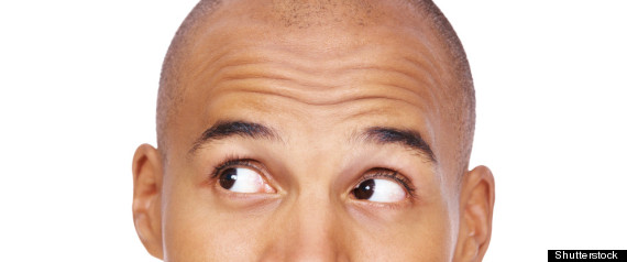  Baldness on Male Baldness  Common Causes Of Hair Loss