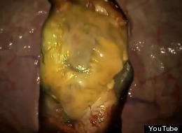 WATCH: Is This What Obesity Looks Like?