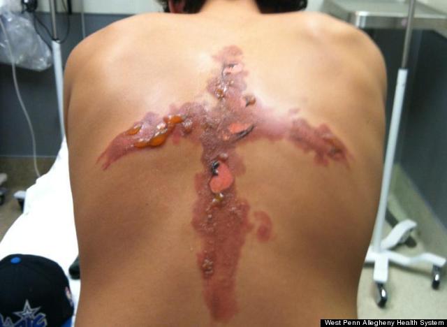 Salt And Ice Challenge: 12-Year-Old Boy Badly Injured After Dangerous Game Burns Cross On His Back S-SALT-BURN-large640