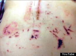 SCARRED: Blind Native American Accuses Hospital Of Giving Him 'KKK' Surgical Scars