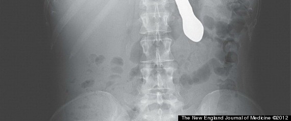Swallows Knife X Ray