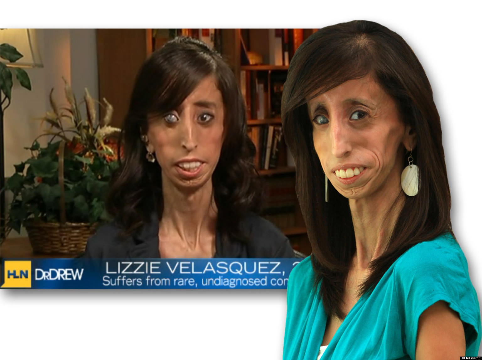 Lizzie Velasquez Nude Telegraph