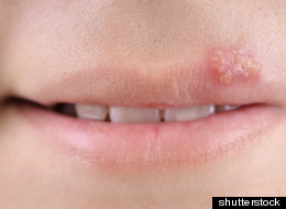 This Cold Sore Prevents The Plague