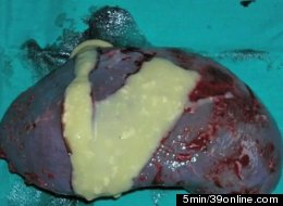 YUCK! This Liver Abcess Was Caused By A Swallowed Toothpick