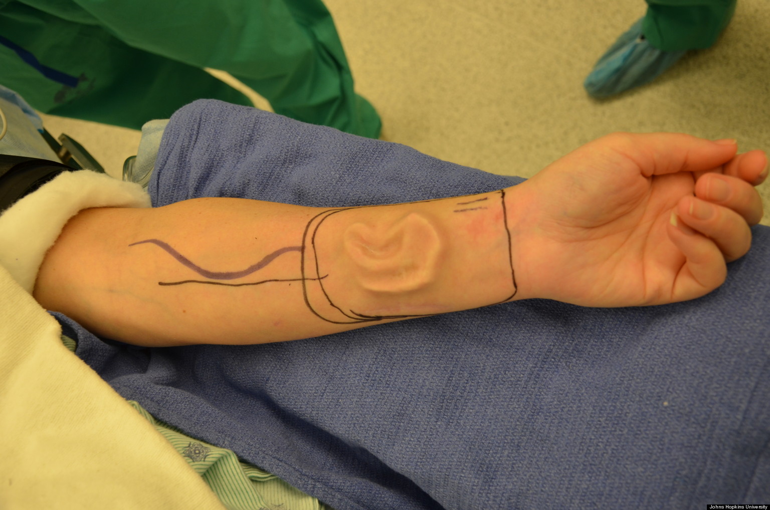 Ear Reconstruction Utilizes Patient's Tissue, Forearm In Innovative