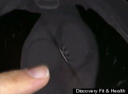 OUCH: 4-Inch Nail Gets Stuck In Heart?