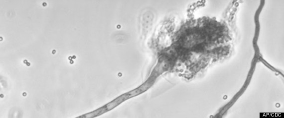 Fungal Meningitis Outbreak
