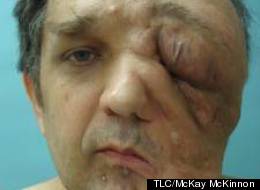 Man Discusses 'My Giant Tumor'