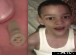 Young Boy Swallows Whistle And Squeaks For Weeks