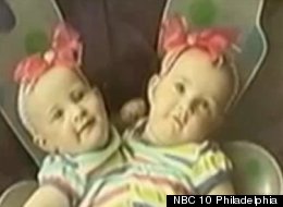 Conjoined Twins Separated At 8 Months