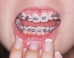 Lisa Kozoriz: I'm 35 and I've Had Braces for Over a Year