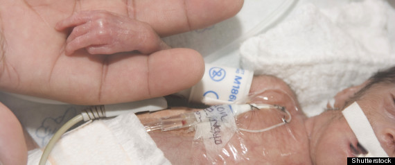 Nacimientos Prematuros
