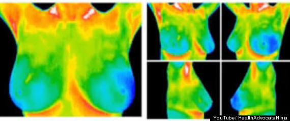Thermography Machines Breast Cancer