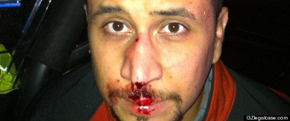 George Zimmerman Bloody Face Photo